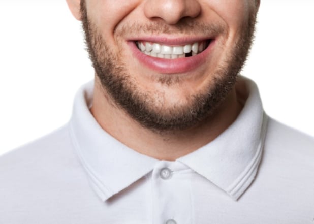 What Causes Tooth Loss?