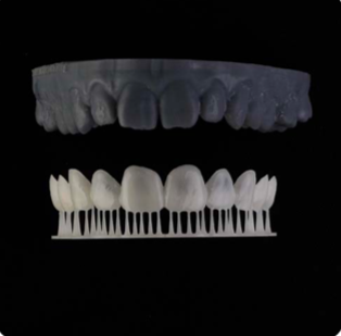 A 3D-printed model of a patient's new smile using Digital Smile Design.