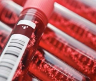 Impact of Liquid Biopsy in Advanced HER2+ Breast Cancer Tumors
