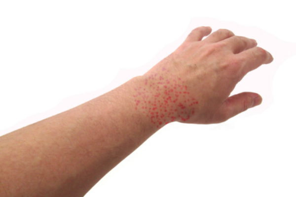 Allergic Reaction on Wrist (Allergies: Causes, Symptoms, Diagnosis, and Treatment)