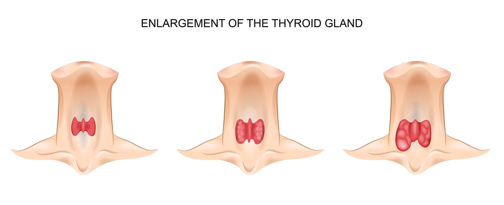 Minimally invasive thyroid surgery - C/V ENT Surgical Group