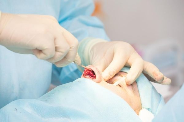 Septoplasty Surgery Los Angeles - C/V ENT Surgical Group