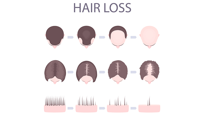 5-common-questions-about-hair-loss-2