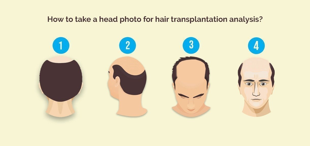 Hair Transplant Photo Guide