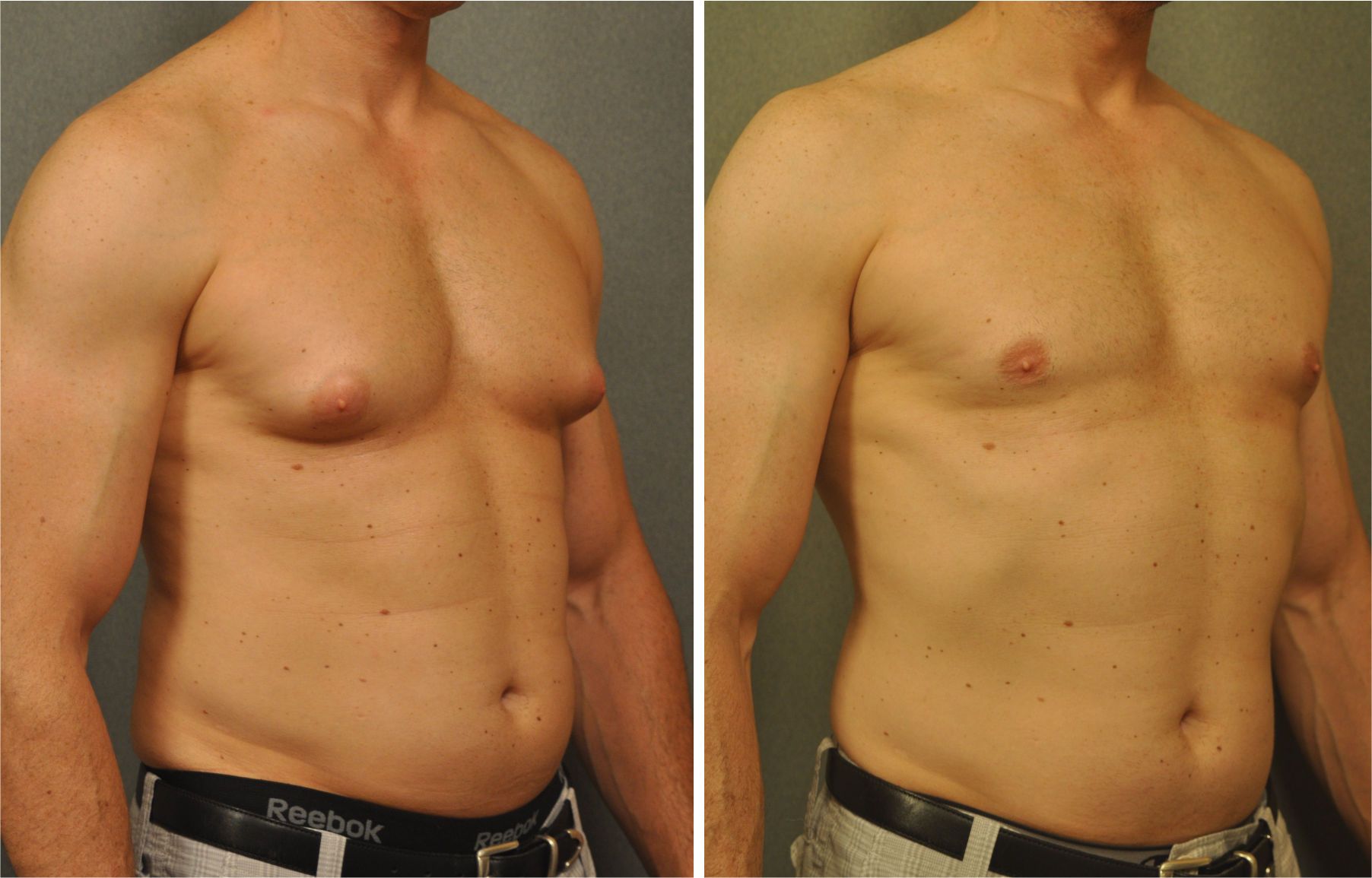 male-liposuction-min-2