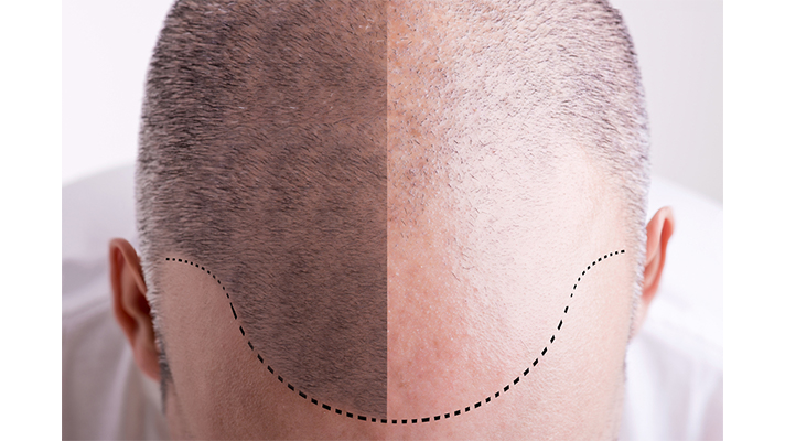 hair-loss-treatment-2
