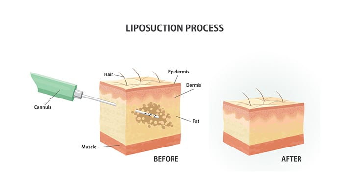 liposuction-guide-1