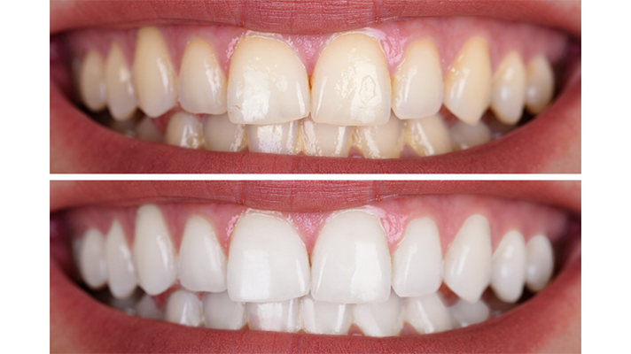 teeth-whitening-1-1
