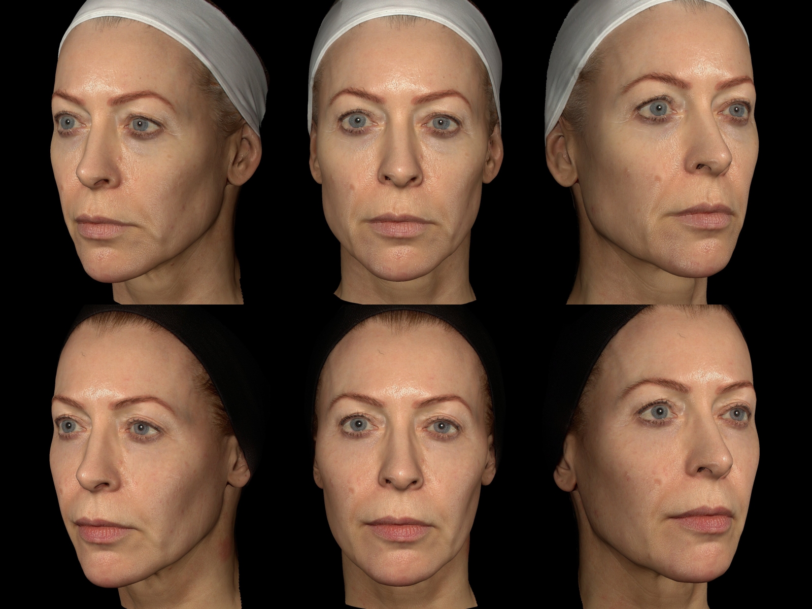 Hart-Davis, Alice Endolift before after (20191129074151960) 20210210114253151