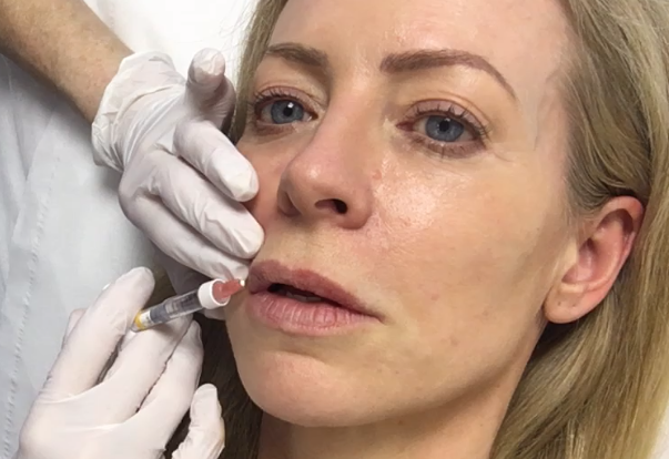 lip filler injections 2