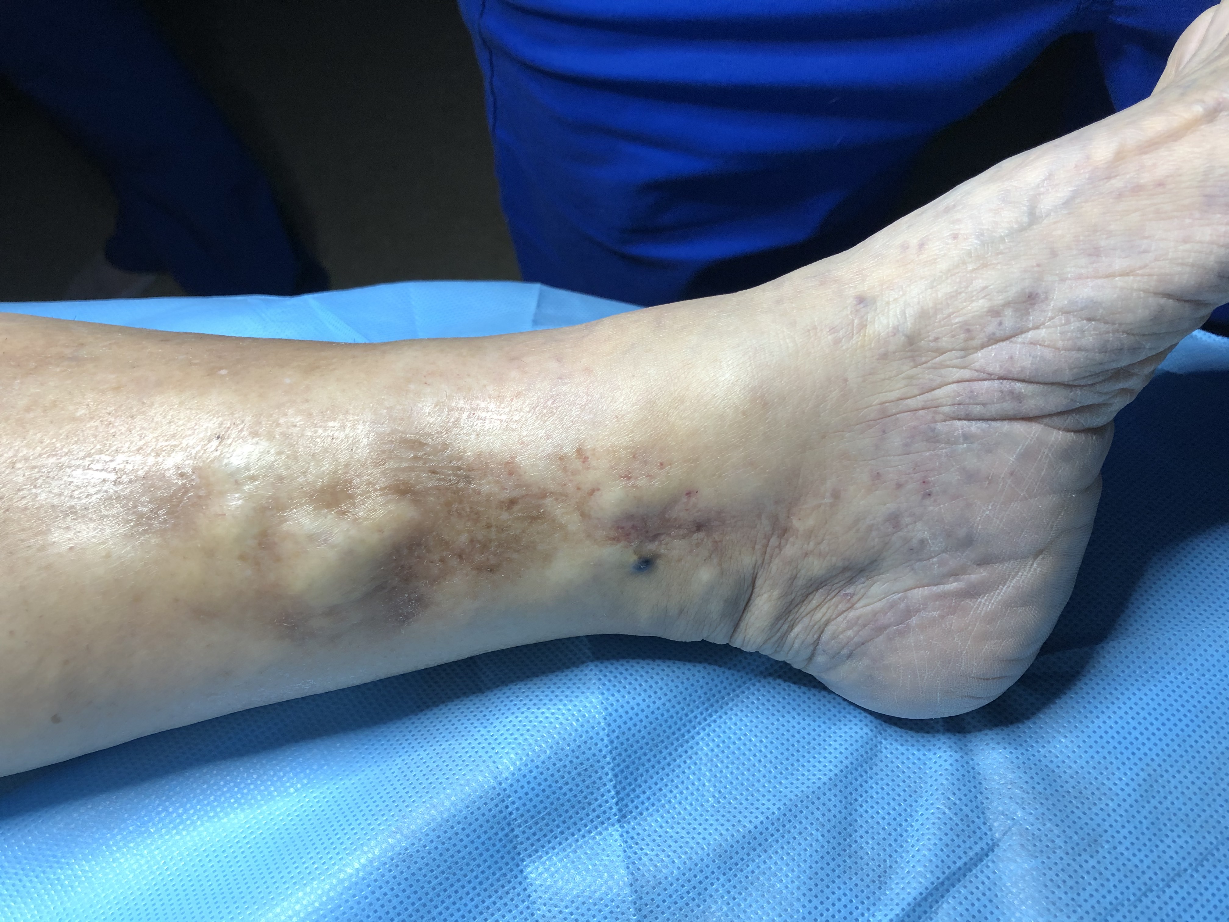 Chronic-venous-insufficiency