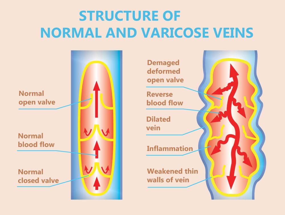 Graph-showing-the-difference-between-a-normal-vein-and-a-vein-with-vein-reflux