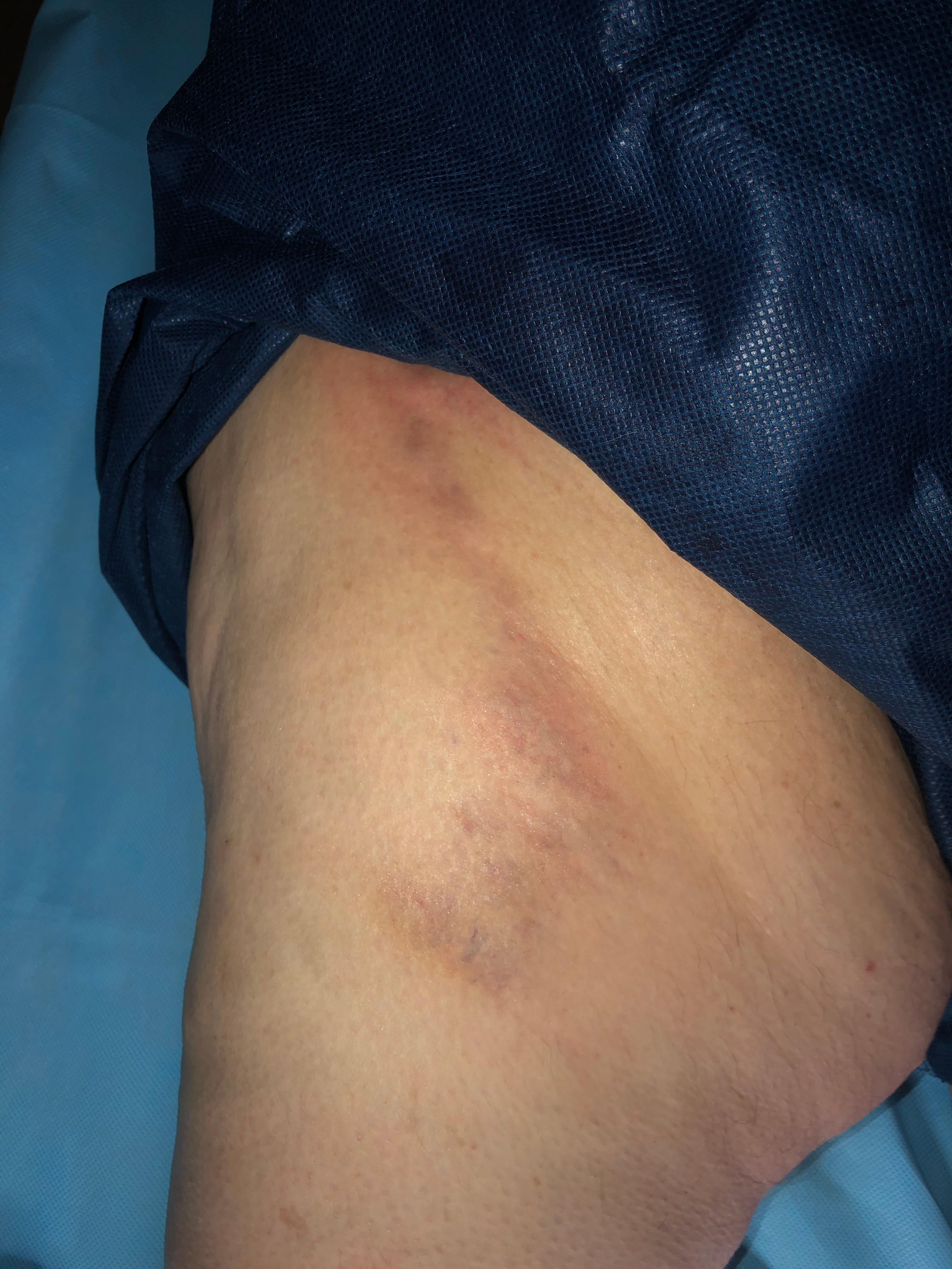 Superificial-phlebitis