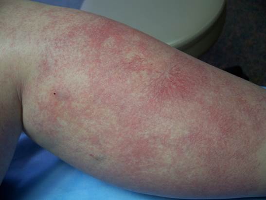 neovascularization