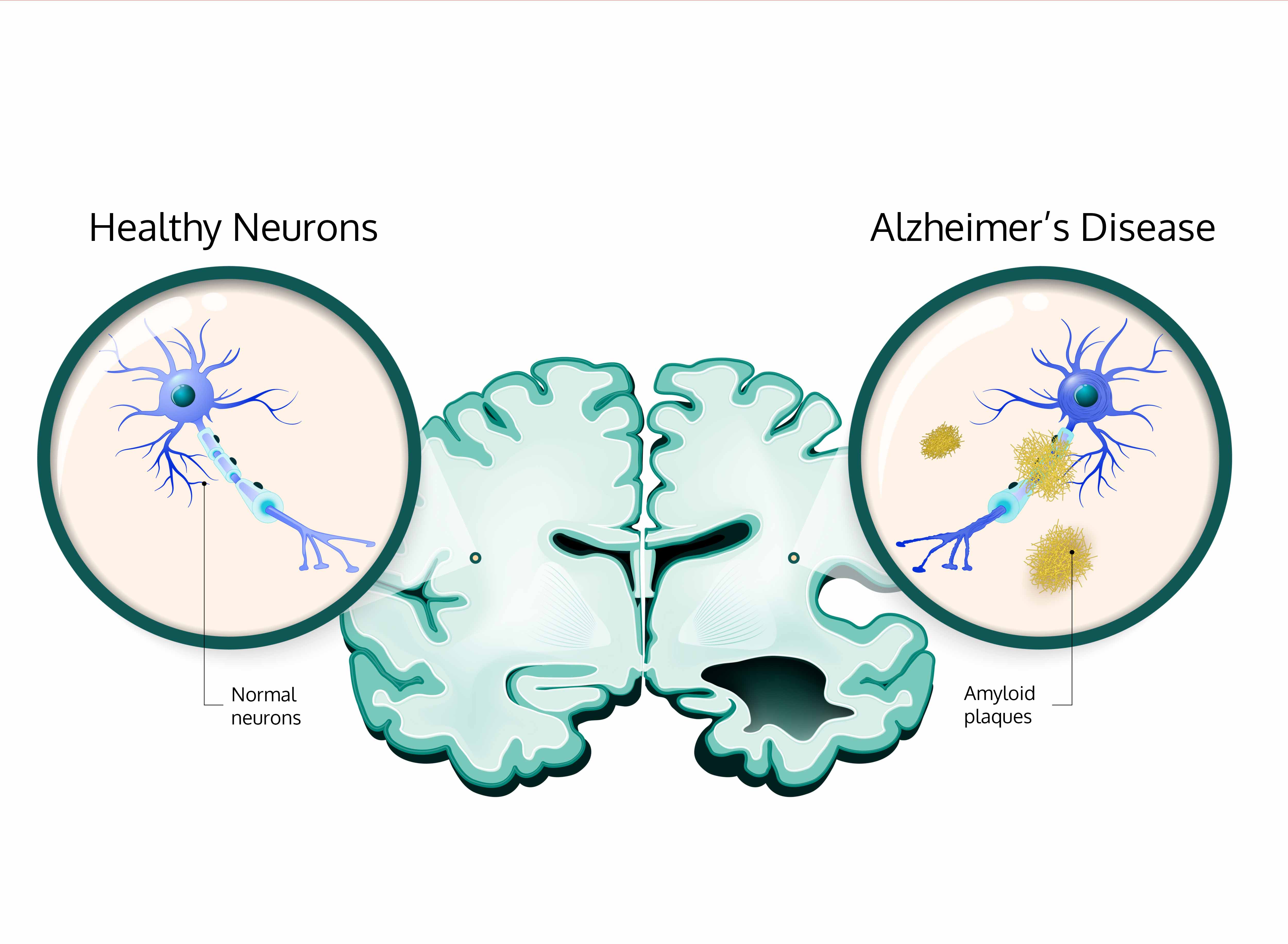 Amyloid brain Alzheimer's disease