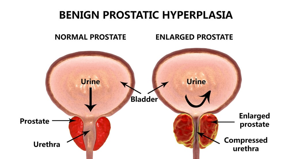 Swollen prostate and the effects of Benign Prostatic Hyperplasia on the urethera