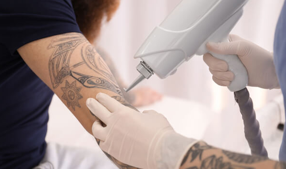 How Does Laser Tattoo Removal Work? - Arizona Medspa | Perfect Skin Center